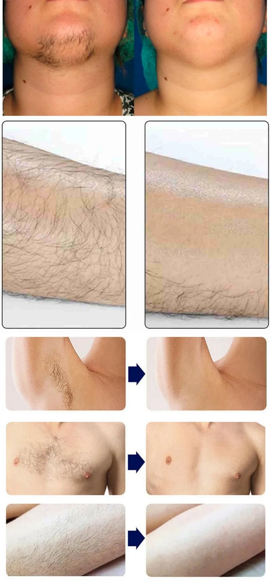Professional Diode Ice Titanium Laser Hair Removal Machine Portable